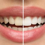 dental-teeth-whitening-graphic dental-teeth-whitening-graphic